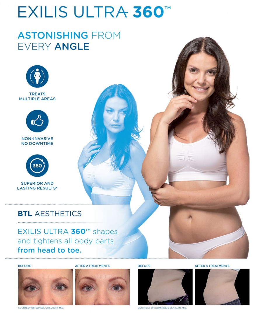 btl exilis ultra 360 London