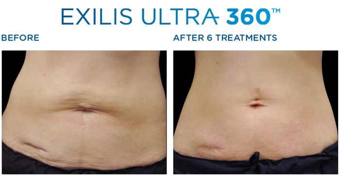 btl exilis ultra 360 treatment london