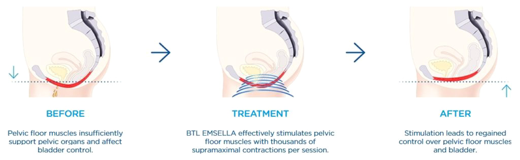 emsella treatment london