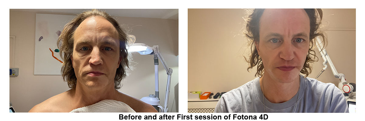  Before and after First session of Fotona 4D